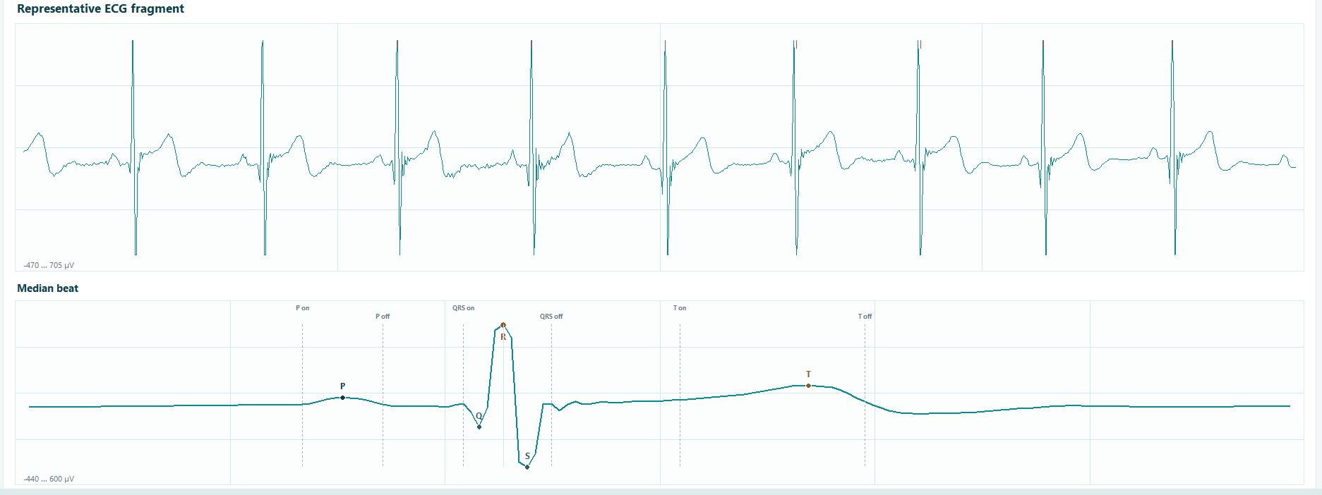 Representative ECG fragment and median beat with P Q R S T points and onset offset markers